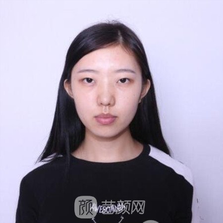 四川省人民醫院傅榮開內眼角+割雙眼皮三個月果分享~